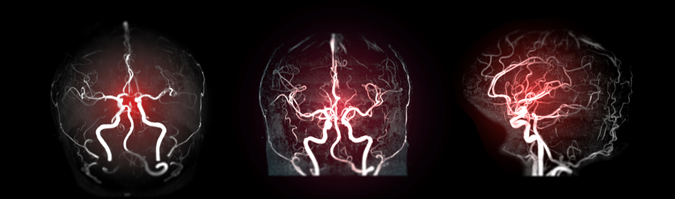 This meta-analysis stratifies doses in order to refine our interpretation of outcomes, and quantify the benefits and harms of tenecteplase at different doses.