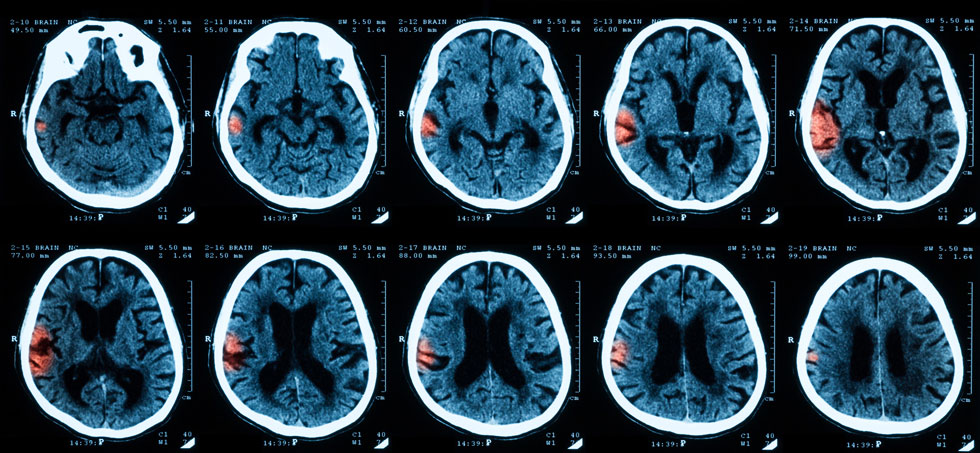 Whether asymptomatic intracranial hemorrhage (ICH) affects the clinical outcomes in patients with acute large vessel occlusion treated with mechanical thrombectomy (MT) remains unclear.