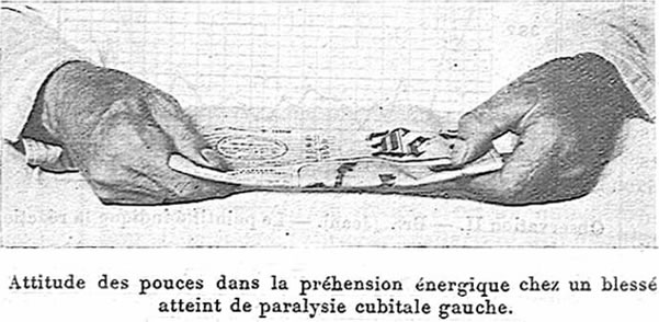 Froment sign (from Presse Médical, Thursday, Oct. 21, 1915).