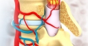 Spinal Cord Disorders