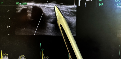 iStock 1737311723Ultrasound of sclerotic plaque in carotid artery