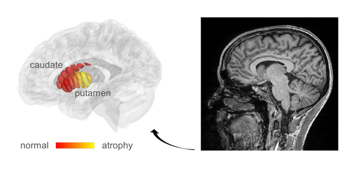 MRI images used for automatic detection of microstructural changes in early-stage Parkinson’s Disease (PD) patients. Marked in yellow are areas in the putamen where PD patients show tissue damage, compared to healthy controls.
