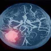 iStock 1239771211 intracerebral hemorrhage