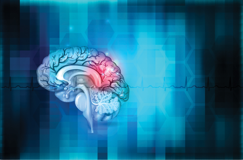 iStock 820680478 stroke joint statement