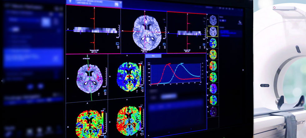 NIH scientists develop technique that provides new insight into stroke