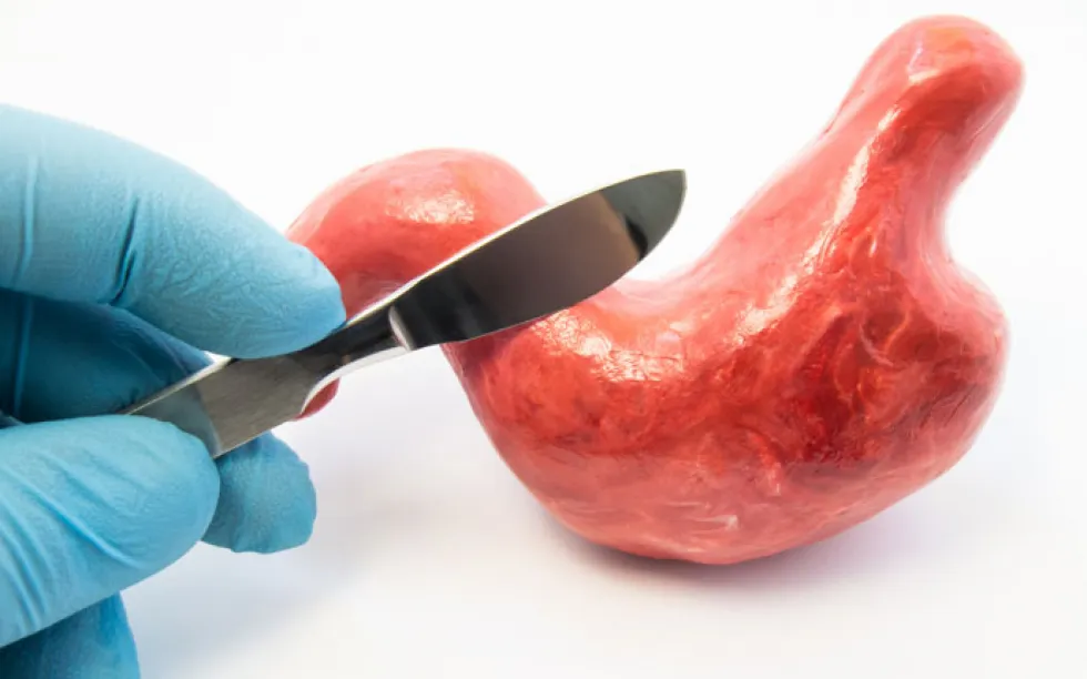 People who have had bariatric surgery may have an increased risk of developing epilepsy, according to study