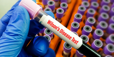 iStock 1449743826 Wilson Disease