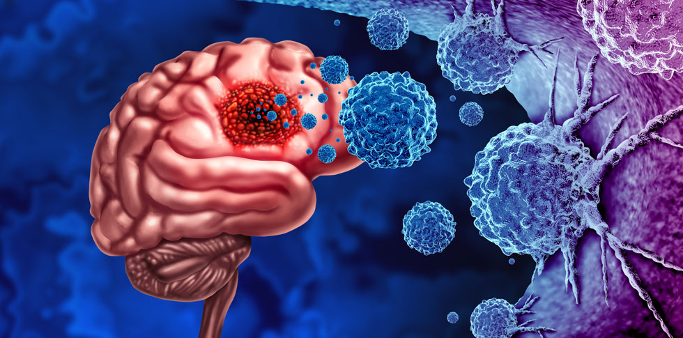 Study could help explain why certain brain tumors don’t respond well to immunotherapy