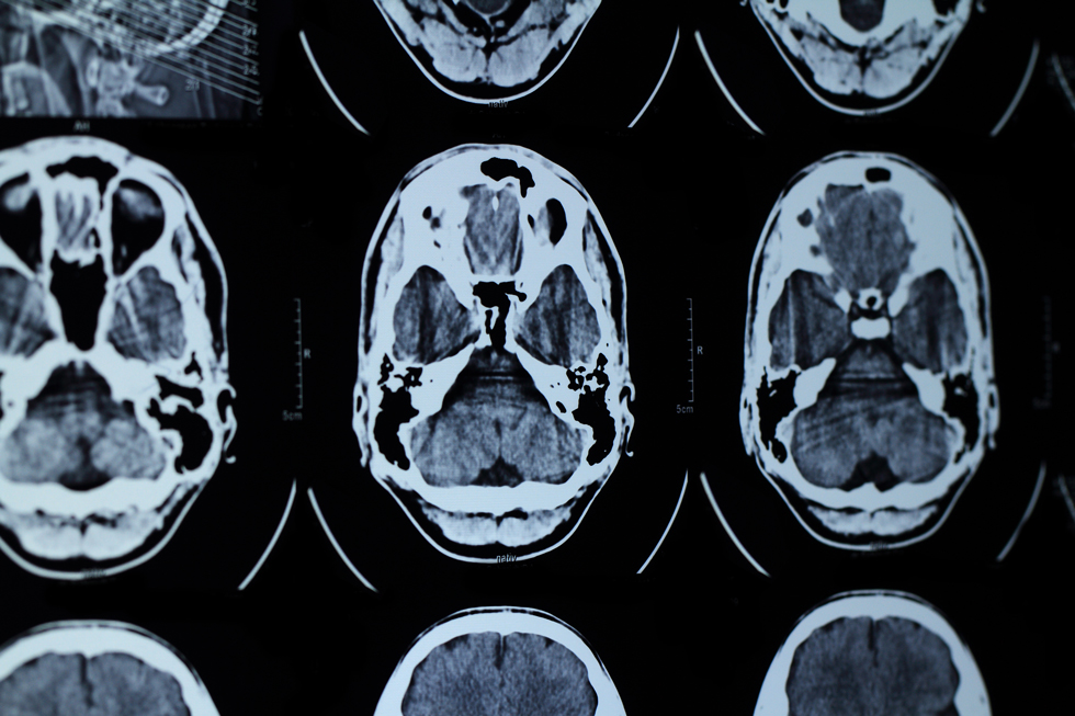 MRI