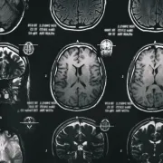 IStock 1246964905 MRI Scan