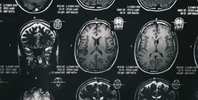 IStock 1246964905 MRI Scan