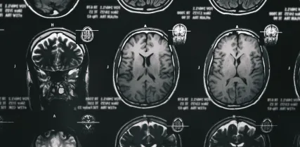 IStock 1246964905 MRI Scan