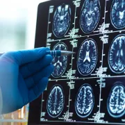 IStock 2221046819 Pointing At Brain Scans
