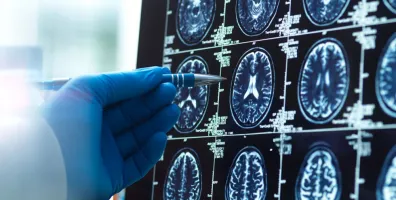 IStock 2221046819 Pointing At Brain Scans