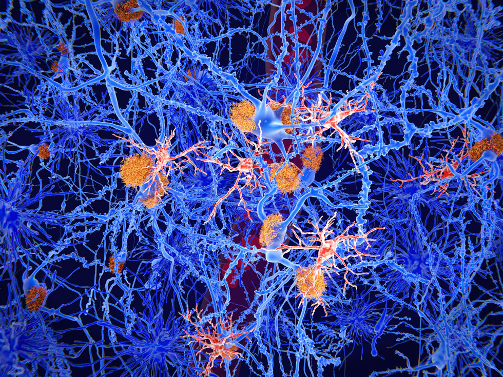 Recent research suggests microglia play a key role in the development and progression of AD and other neurodegenerative disorders