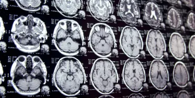 IStock 641048776 MRI Scans