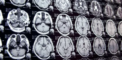 IStock 641048776 MRI Scans