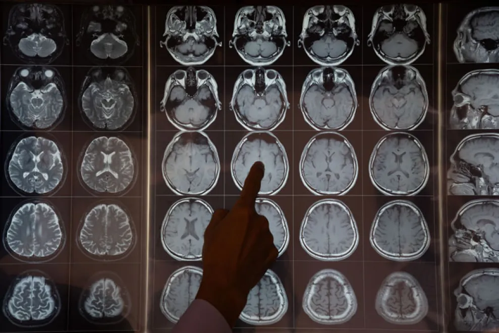 IStock 2167998369 Neuroimaging