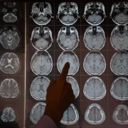 IStock 2167998369 Neuroimaging