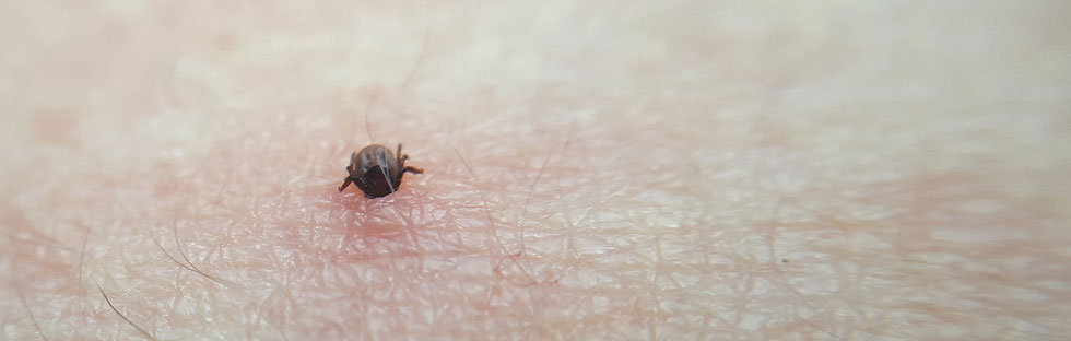The clinical diagnosis of this disease, which is caused by infections from tick bites, is still difficult and often occurs long after infection.