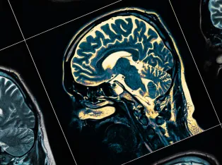 IStock 1140748326 MRI Scan