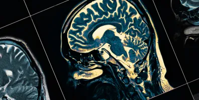 IStock 1140748326 MRI Scan