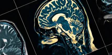 IStock 1140748326 MRI Scan