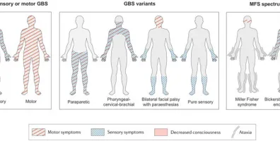 JNS Editors Choice Autoimmune Neuropathies