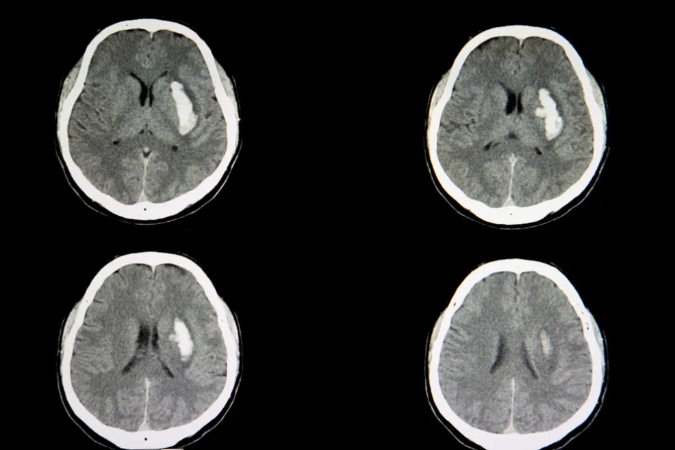 IStock 1056146830 Intracerebral Hemorrhage