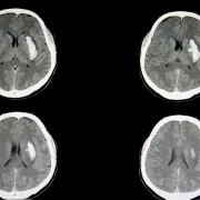 IStock 1056146830 Intracerebral Hemorrhage