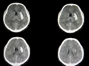 IStock 1056146830 Intracerebral Hemorrhage