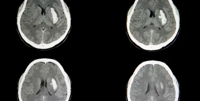 IStock 1056146830 Intracerebral Hemorrhage