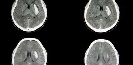 IStock 1056146830 Intracerebral Hemorrhage