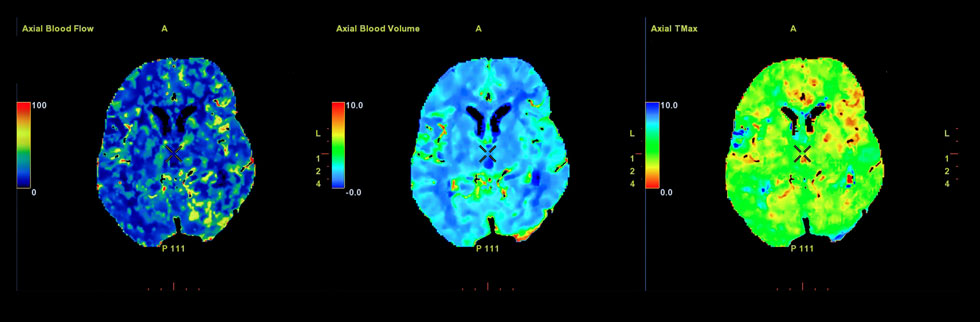 A large study led by Lund University in Sweden has shown that people with Alzheimer's disease can now be identified before they experience any symptoms.