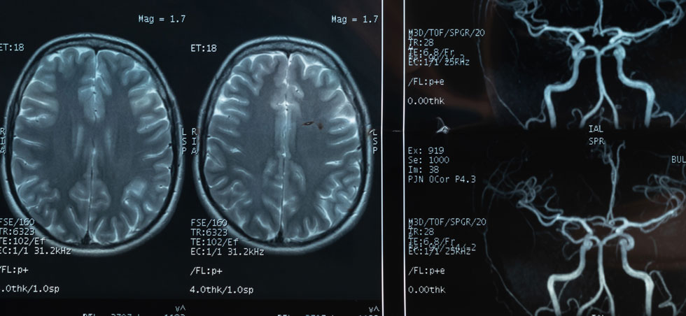 This study aimed to analyse magnetic resonance imaging (MRI) findings, and clinical characteristics, in patients with WE who have confirmed low blood VB1 levels.