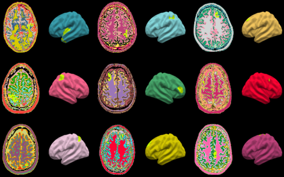 Brain abnormalities identified by the MELD AI algorithm (highlighted in lime green) on MRI scans of children and adults with epilepsy from around the world by Dr Konrad Wagstyl.
