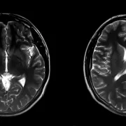 iStock 1306274835 Brain WhiteMatter