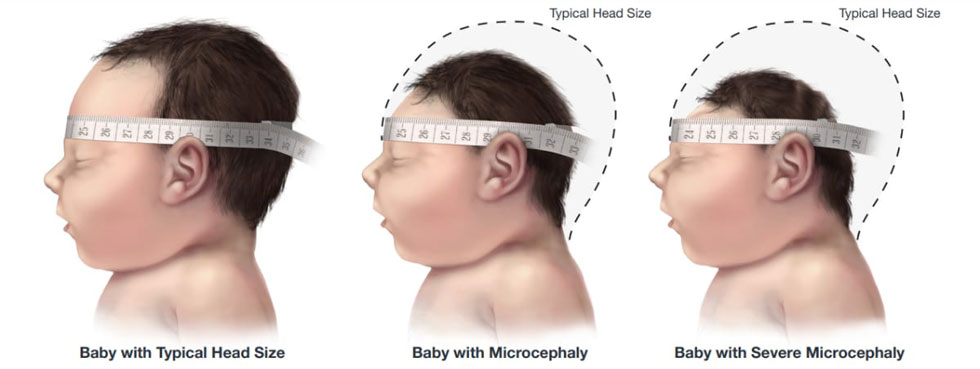 Babies with microcephaly have a smaller head than expected for their age and sex.