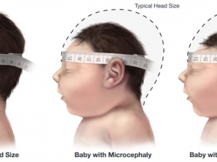 Babies with microcephaly have a smaller head than expected for their age and sex.